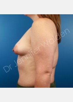 Before Image: Breast Augmentation - front