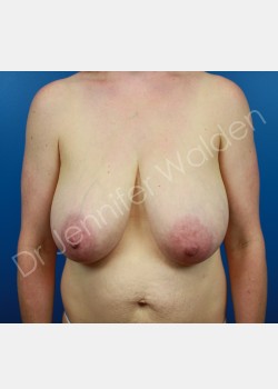 Before Image: Breast Augmentation with Lift - front