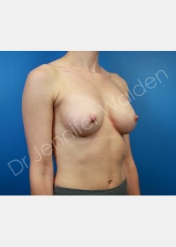 After Image: Breast Augmentation - front