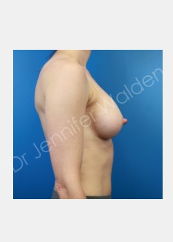 After Image: Breast Augmentation - front