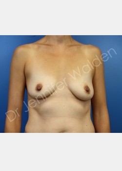 Before Image: Breast Augmentation - front