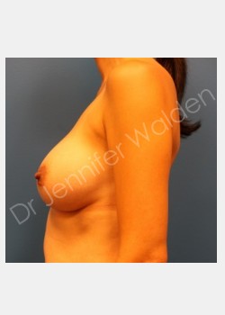 After Image: Breast Augmentation - front