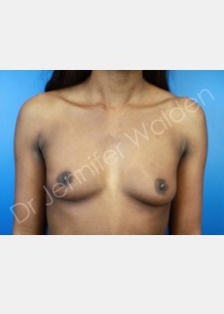 Before Image: Breast Augmentation - front