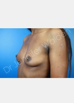 Before Image: Breast Augmentation - front