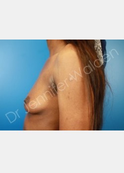 Before Image: Breast Augmentation - front