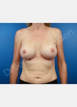 After Image: Breast Augmentation - front
