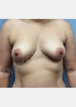 Before Image: Breast Augmentation - front