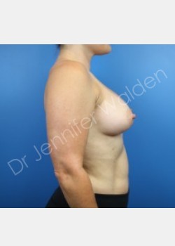 After Image: Breast Augmentation - front