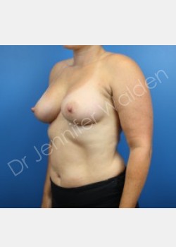 After Image: Breast Augmentation - front