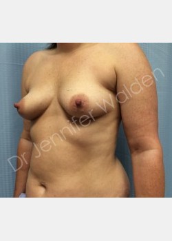 Before Image: Breast Augmentation - front