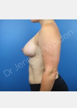 After Image: Breast Augmentation - front