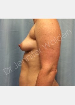 Before Image: Breast Augmentation - front