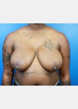 Before Image: Breast Reduction - front