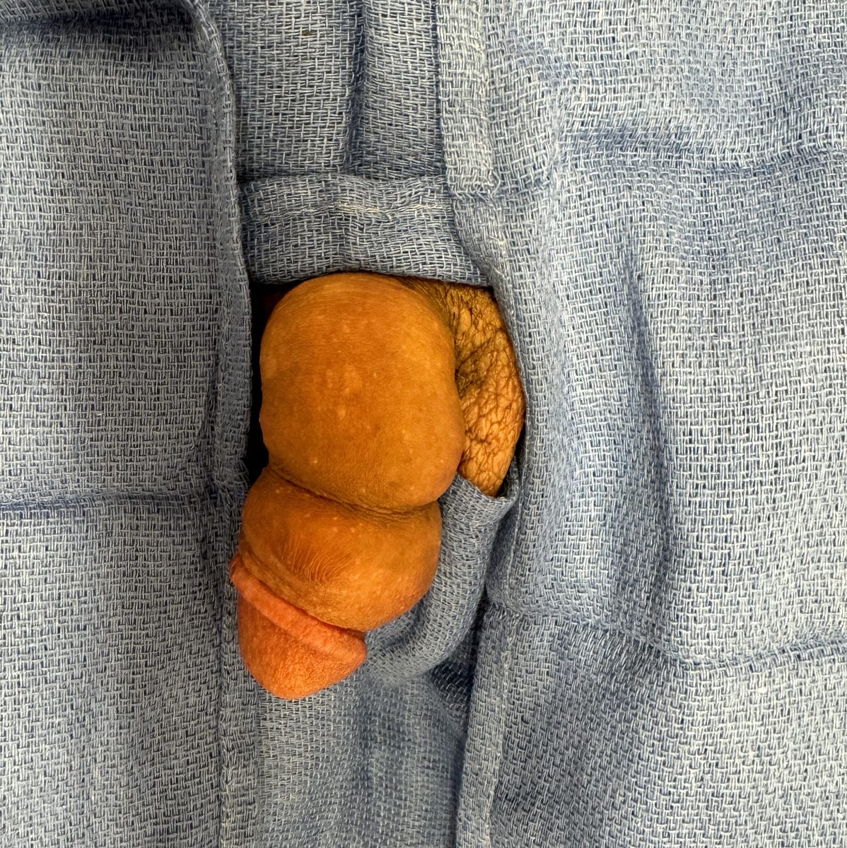 J-Shot Case 4 – before and after photo