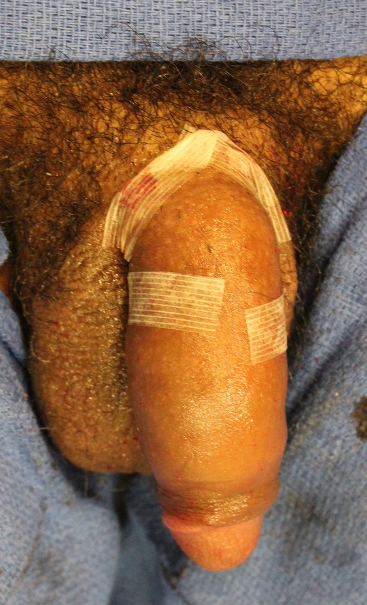 J-Shot Case 5 – before and after photo